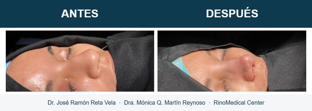 Rinoplastia, cambio inmediato en quirófano, caso 1 — Dr. José Ramón Reta Vela y Dra. Mónica Q. Martín Reynoso, RinoMedical Center Hermosillo