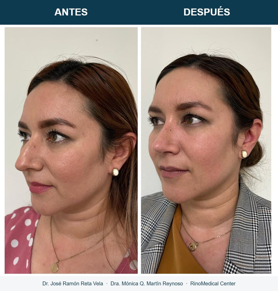 Rinoplastia, cambio inmediato en quirófano, caso 2 — Dr. José Ramón Reta Vela y Dra. Mónica Q. Martín Reynoso, RinoMedical Center Hermosillo
