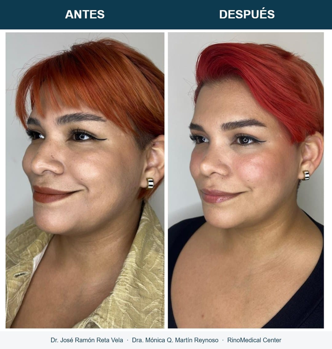 Rinoplastia, cambio inmediato en quirófano, caso 3 — Dr. José Ramón Reta Vela y Dra. Mónica Q. Martín Reynoso, RinoMedical Center Hermosillo