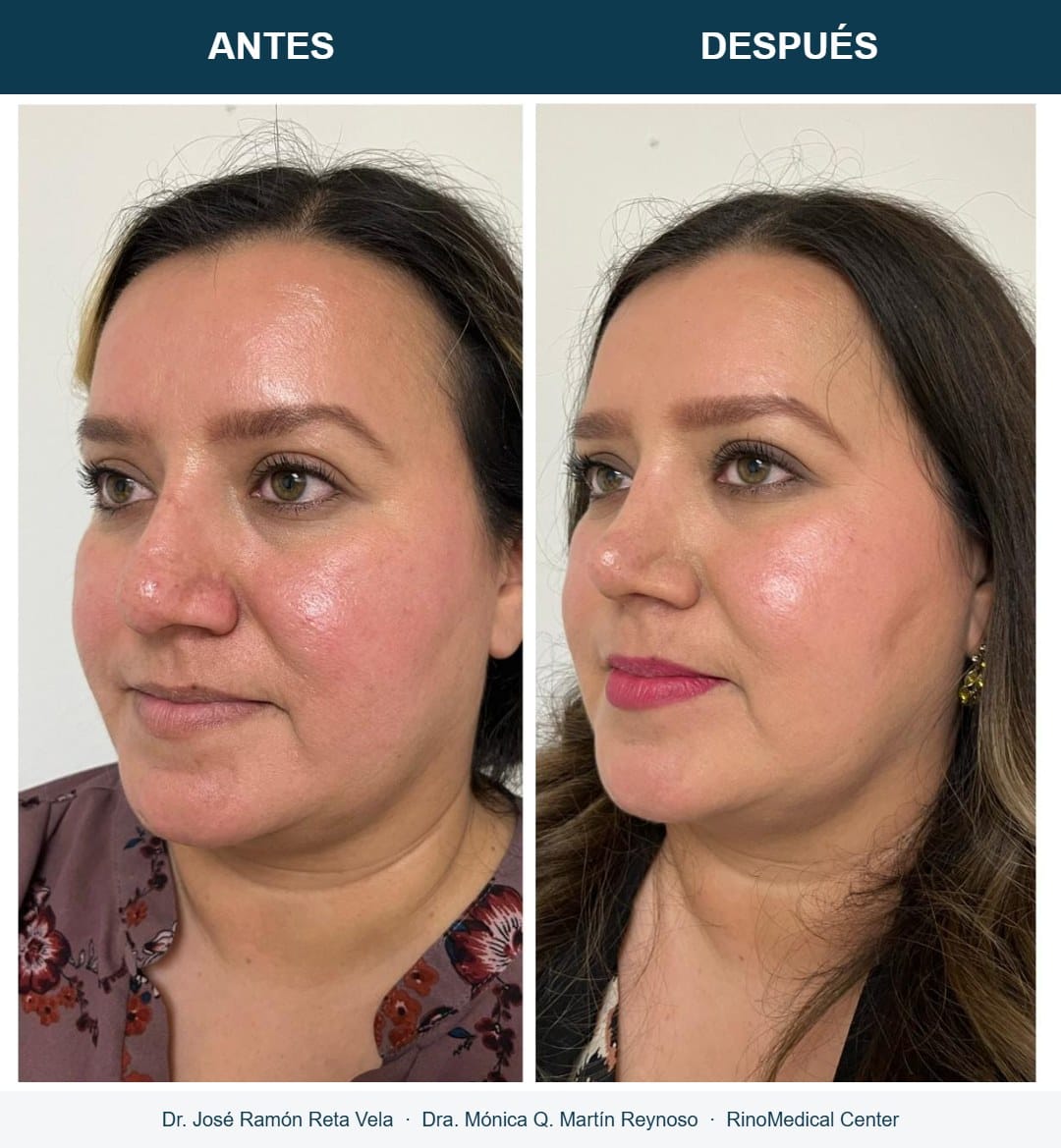 Rinoplastia, cambio inmediato en quirófano, caso 4 — Dr. José Ramón Reta Vela y Dra. Mónica Q. Martín Reynoso, RinoMedical Center Hermosillo