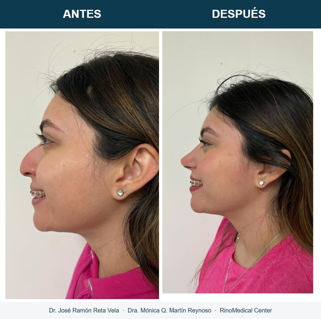 Rinoplastia, cambio inmediato en quirófano, caso 5 — Dr. José Ramón Reta Vela y Dra. Mónica Q. Martín Reynoso, RinoMedical Center Hermosillo