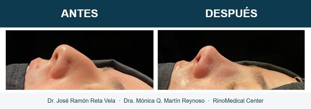 Rinoplastia, cambio inmediato en quirófano, caso 7 — Dr. José Ramón Reta Vela y Dra. Mónica Q. Martín Reynoso, RinoMedical Center Hermosillo