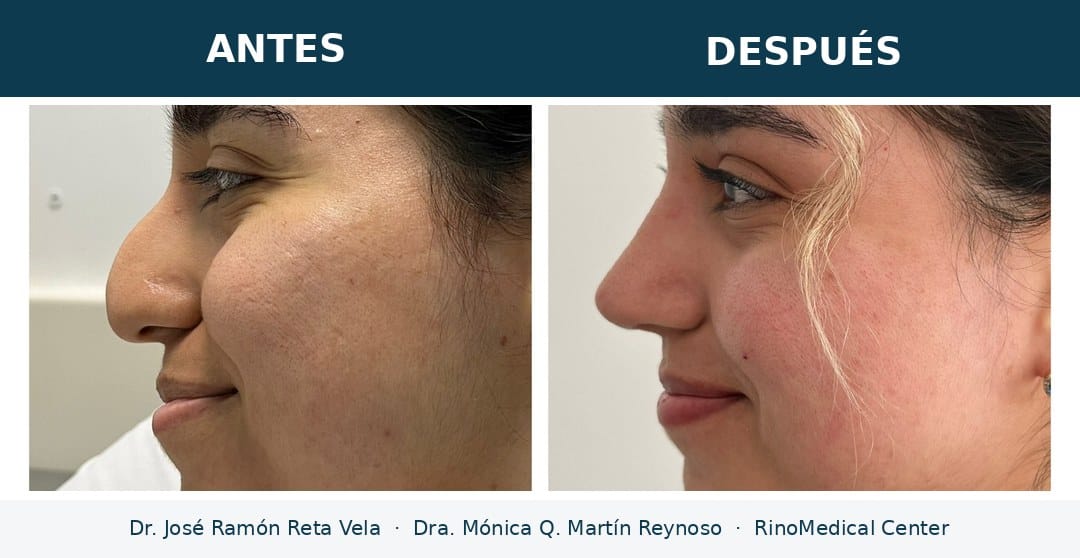 Rinoplastia antes y después, paciente 1 — Dr. José Ramón Reta Vela y Dra. Mónica Q. Martín Reynoso, RinoMedical Center Hermosillo
