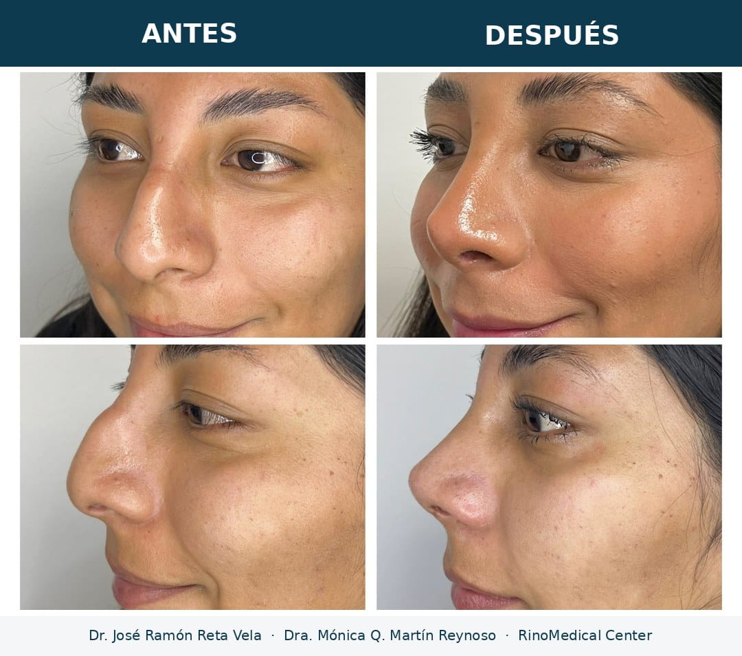 Rinoplastia antes y después, paciente 2 — Dr. José Ramón Reta Vela y Dra. Mónica Q. Martín Reynoso, RinoMedical Center Hermosillo