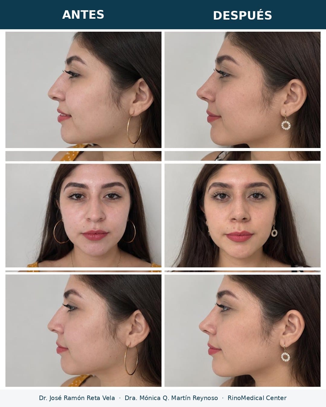 Rinoplastia antes y después, paciente 3 — Dr. José Ramón Reta Vela y Dra. Mónica Q. Martín Reynoso, RinoMedical Center Hermosillo