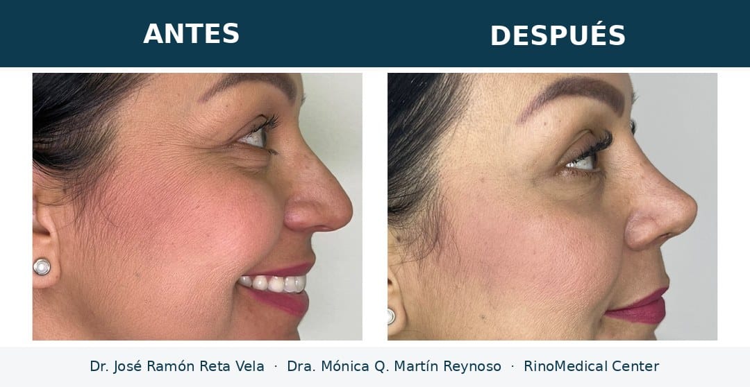 Rinoplastia antes y después, paciente 4 — Dr. José Ramón Reta Vela y Dra. Mónica Q. Martín Reynoso, RinoMedical Center Hermosillo