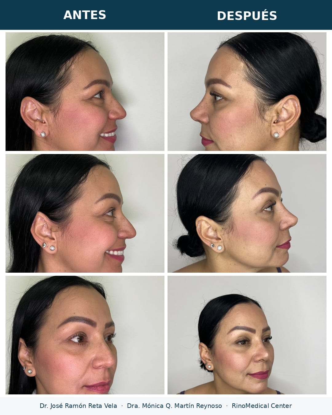 Rinoplastia antes y después, paciente 4, tres vistas — Dr. José Ramón Reta Vela y Dra. Mónica Q. Martín Reynoso, RinoMedical Center Hermosillo