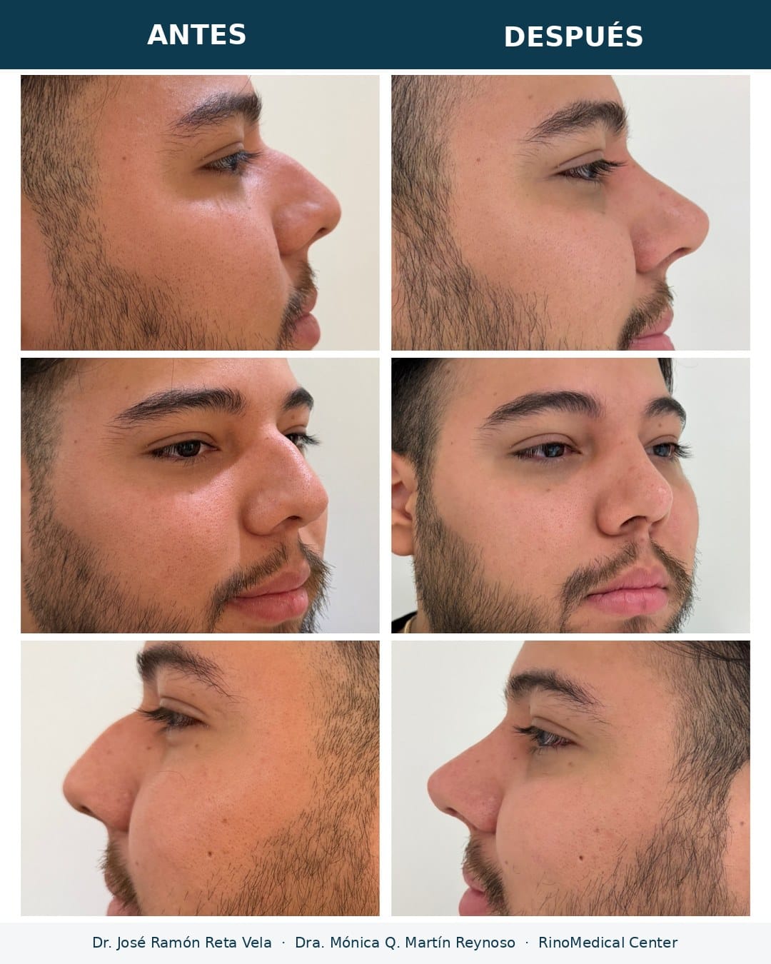 Rinoplastia antes y después, paciente 5 — Dr. José Ramón Reta Vela y Dra. Mónica Q. Martín Reynoso, RinoMedical Center Hermosillo