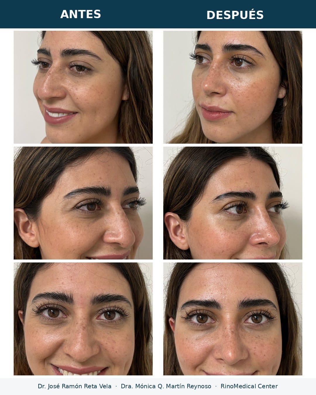 Rinoplastia antes y después, paciente 6 — Dr. José Ramón Reta Vela y Dra. Mónica Q. Martín Reynoso, RinoMedical Center Hermosillo
