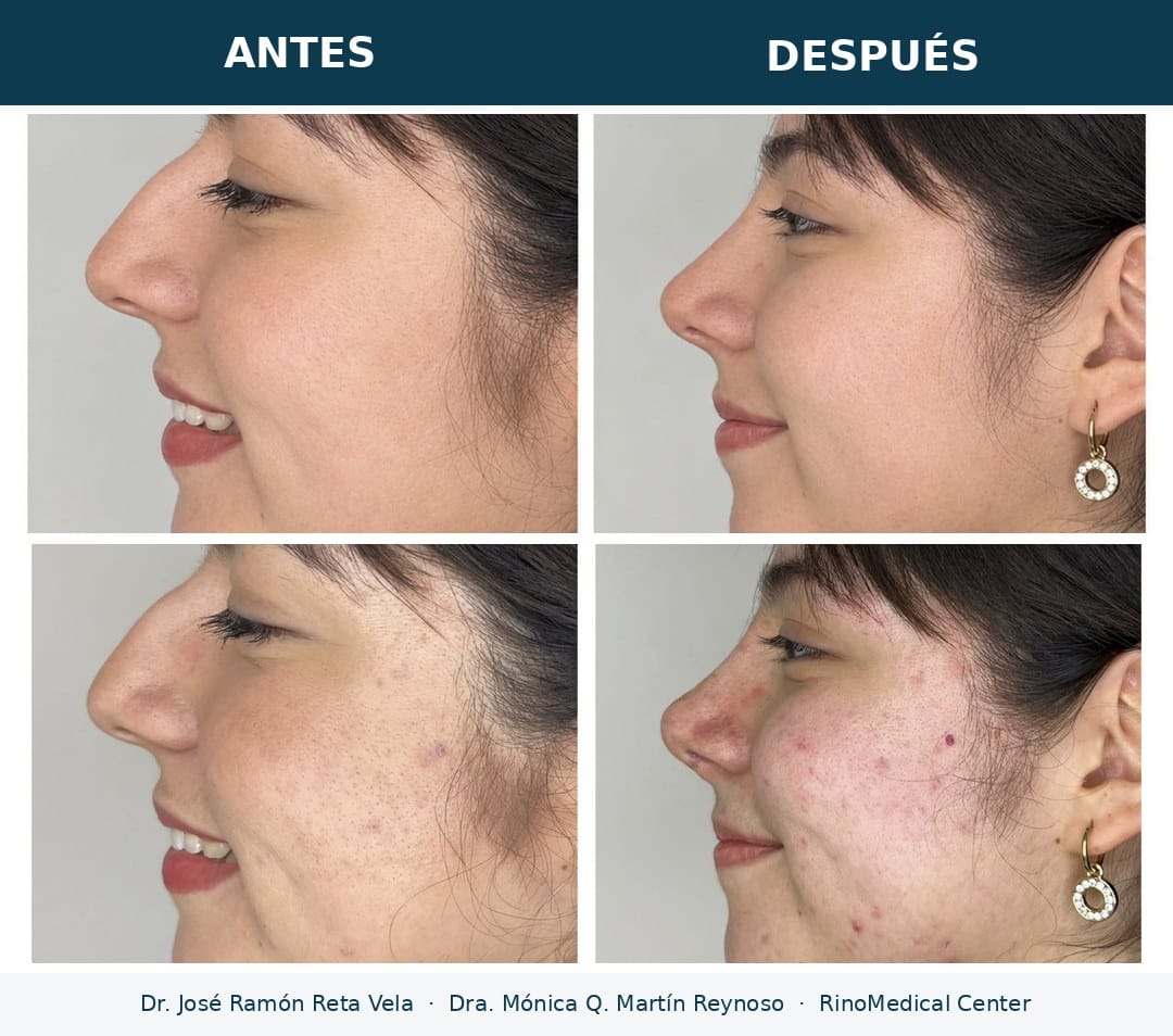 Rinoplastia antes y después, paciente 7 — Dr. José Ramón Reta Vela y Dra. Mónica Q. Martín Reynoso, RinoMedical Center Hermosillo