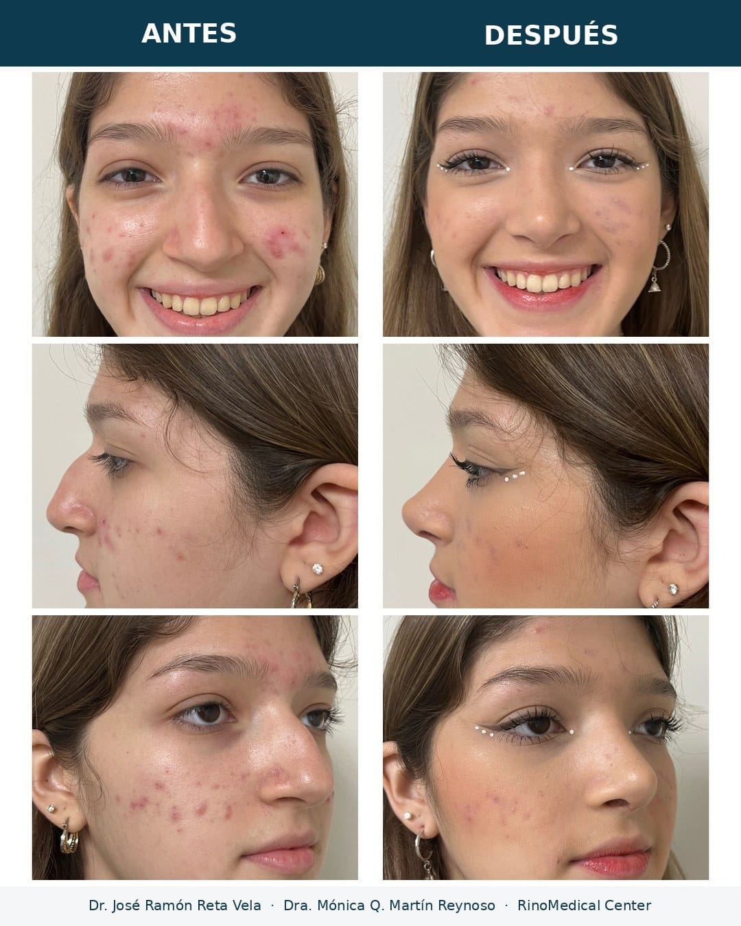 Rinoplastia antes y después, paciente 8 — Dr. José Ramón Reta Vela y Dra. Mónica Q. Martín Reynoso, RinoMedical Center Hermosillo