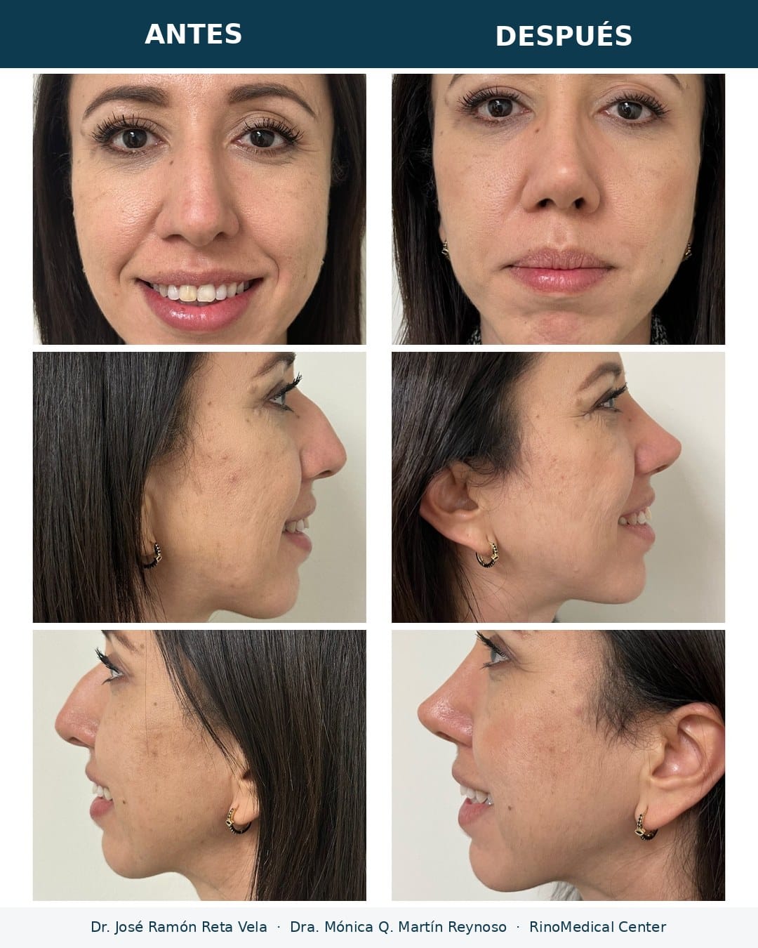 Rinoplastia antes y después, paciente 9 — Dr. José Ramón Reta Vela y Dra. Mónica Q. Martín Reynoso, RinoMedical Center Hermosillo
