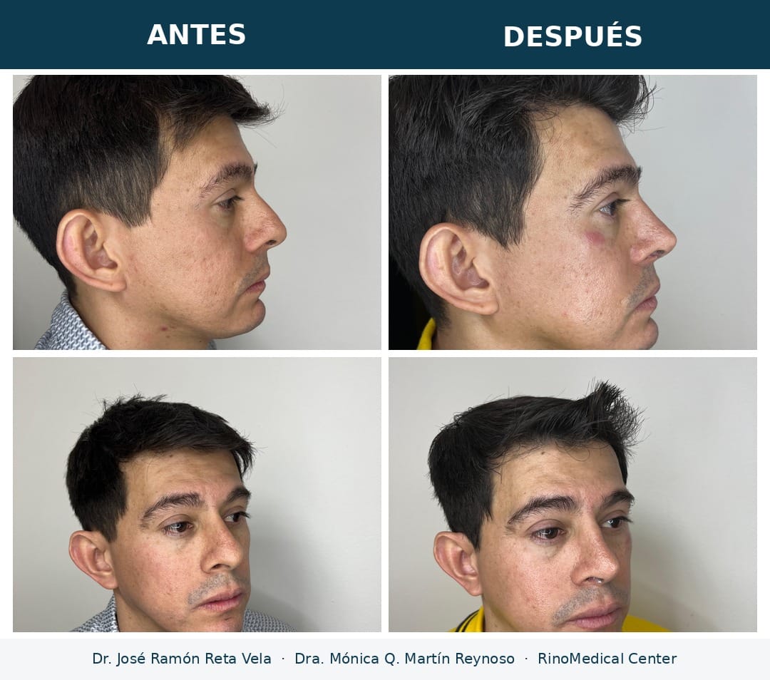 Rinoplastia en hombre, antes y después — Dr. José Ramón Reta Vela y Dra. Mónica Q. Martín Reynoso, RinoMedical Center Hermosillo