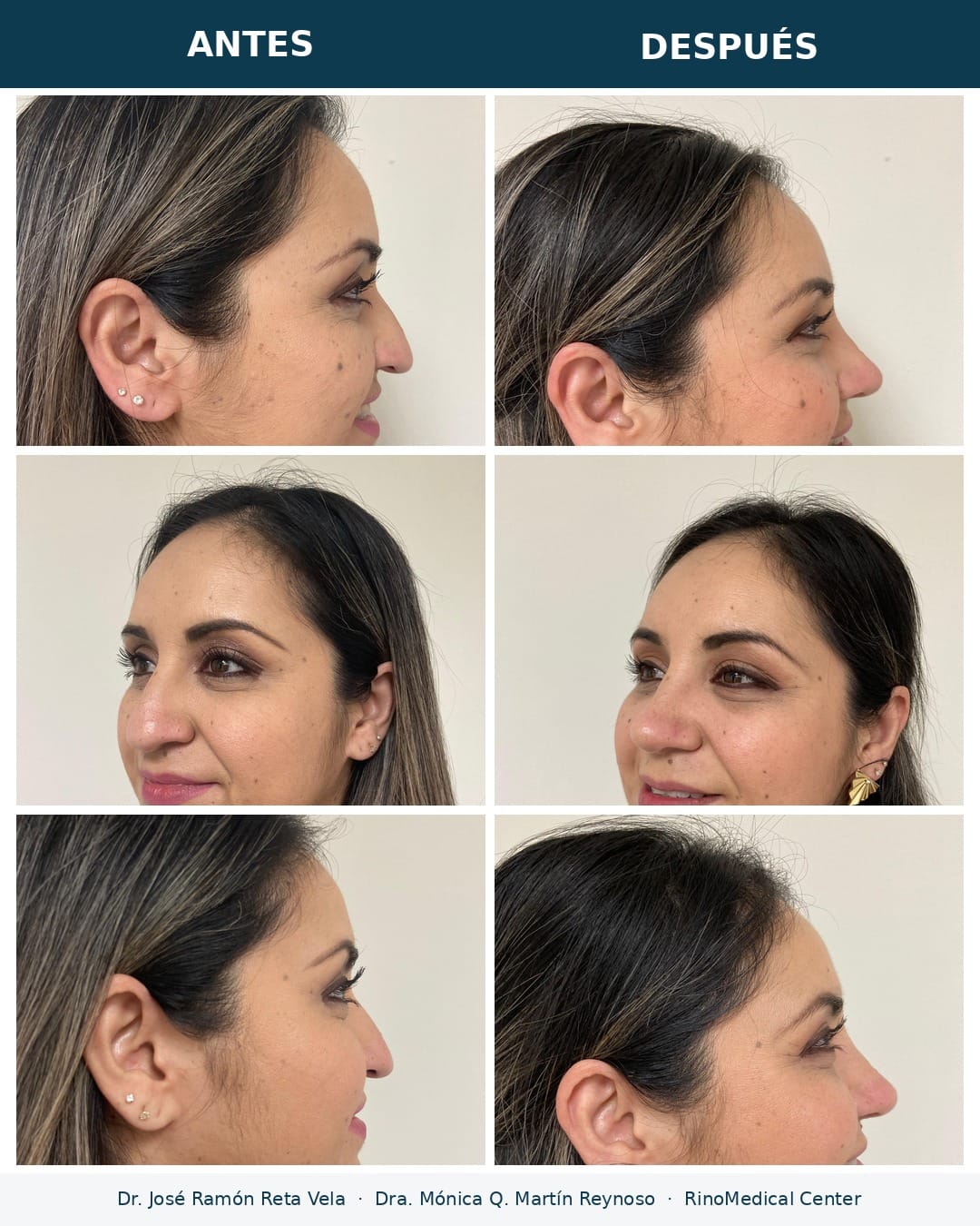 Rinoplastia antes y después en tres vistas — Dr. José Ramón Reta Vela y Dra. Mónica Q. Martín Reynoso, RinoMedical Center Hermosillo
