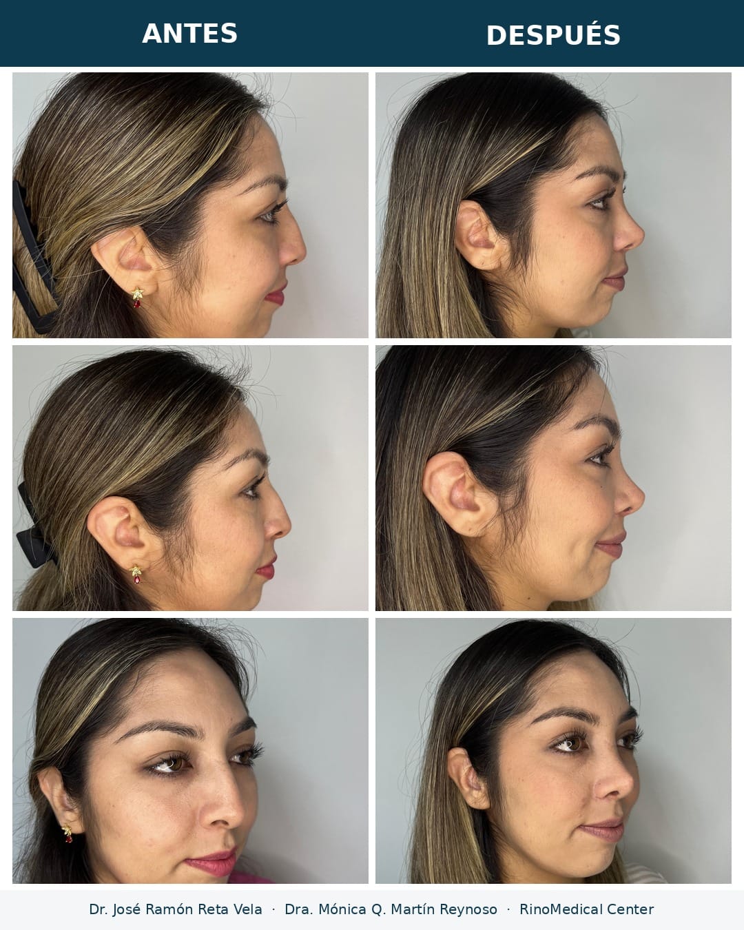 Rinoplastia antes y después en tres vistas — Dr. José Ramón Reta Vela y Dra. Mónica Q. Martín Reynoso, RinoMedical Center Hermosillo