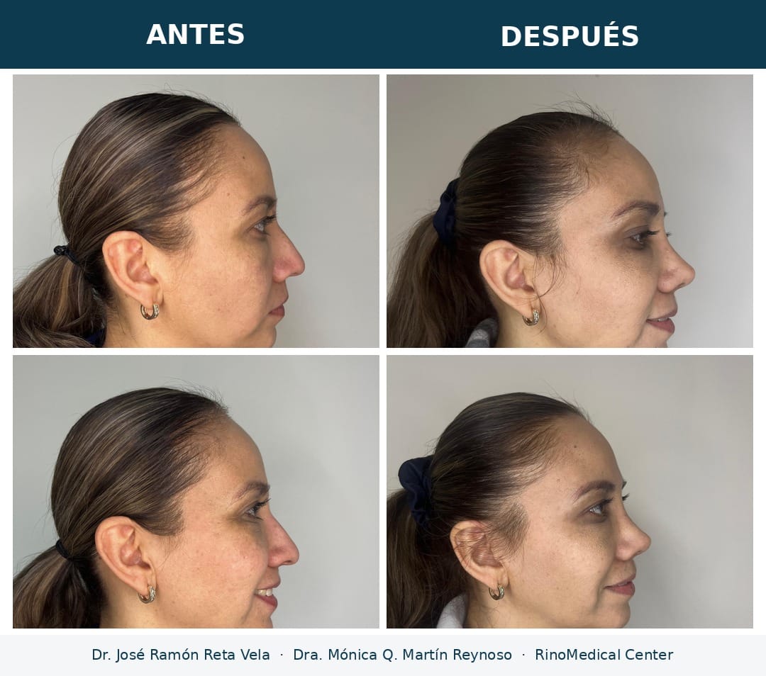 Rinoplastia antes y después, perfil — Dr. José Ramón Reta Vela y Dra. Mónica Q. Martín Reynoso, RinoMedical Center Hermosillo
